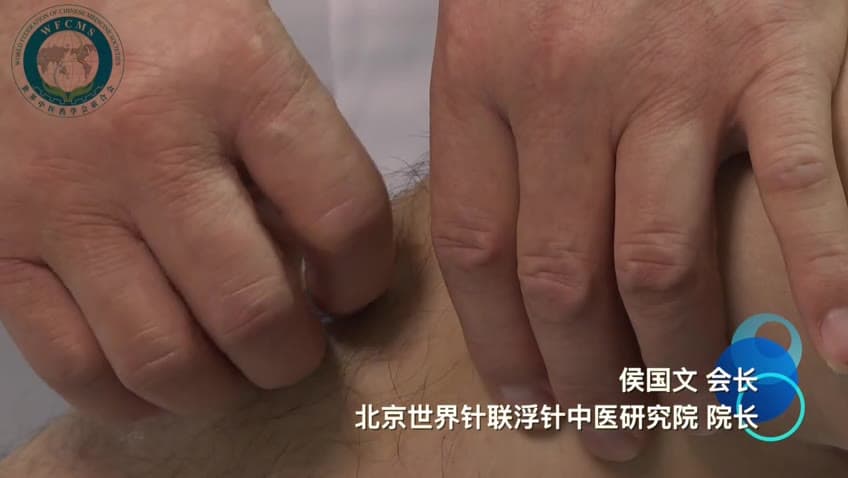 侯国文：套针治疗膝关节滑膜炎 — 世中联套针专业委员会