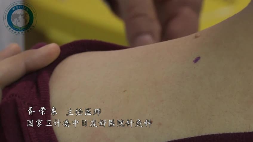 胥荣东：套针治疗颈椎病