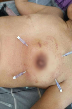 乳腺增生的套针综合治疗