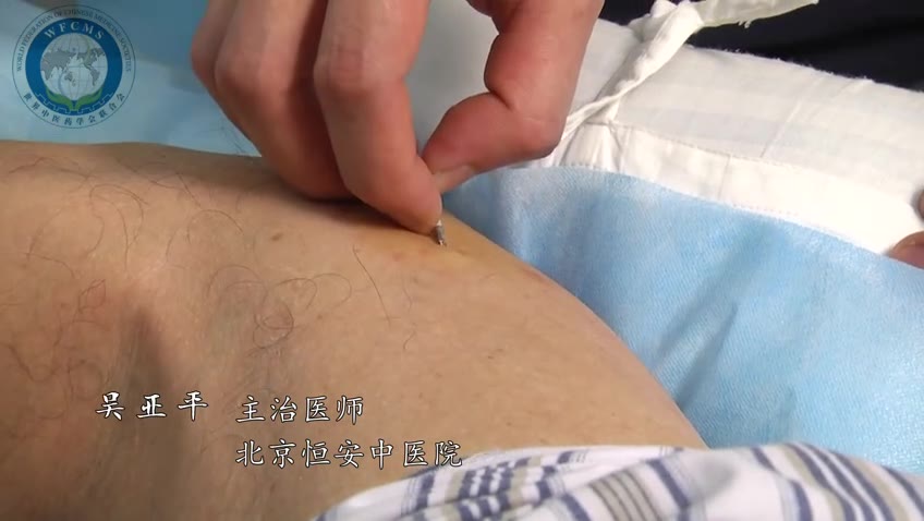 吴亚平：套针治疗腰椎间盘突出症
