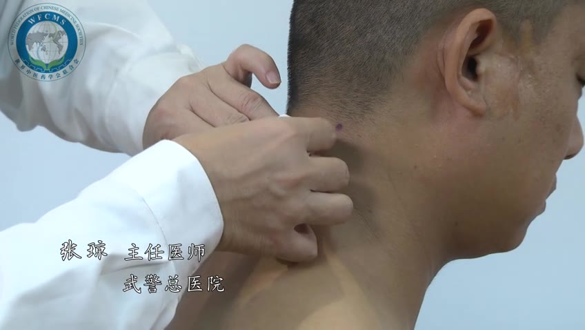 张琼：套针治疗颈椎病